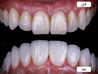 قبل لمینیت